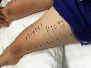 Sports Integrated Dry-Needling Lower body
